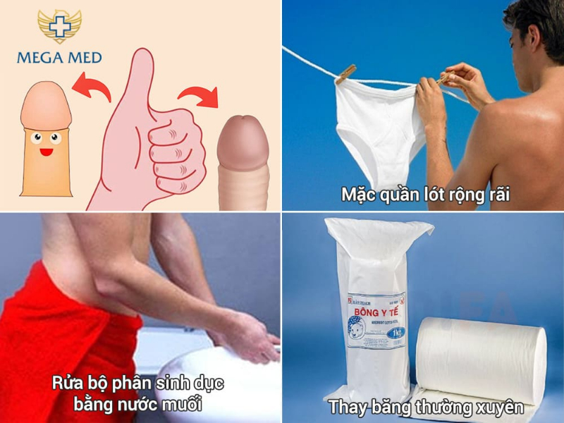 Lưu ý quan trọng sau khi cắt bao quy đầu 